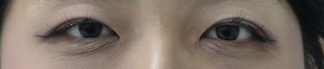 ศัลยกรรมตา — ก่อนทำ
