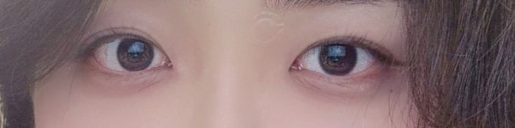 ศัลยกรรมตา — หลังทำ