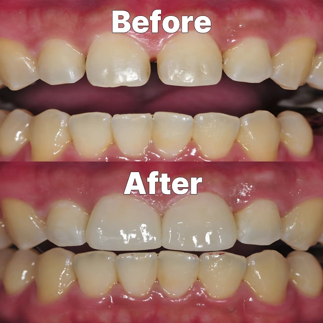 Laminate veneers — Before and after