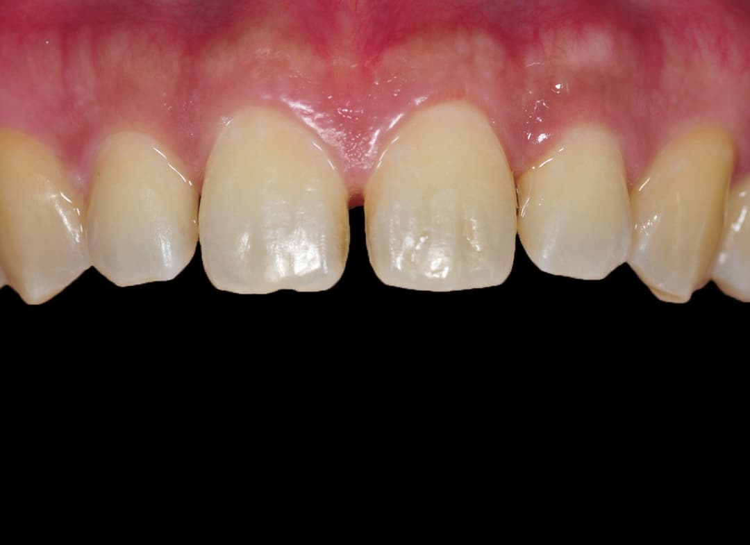 Ceramic procedure — Before treatment