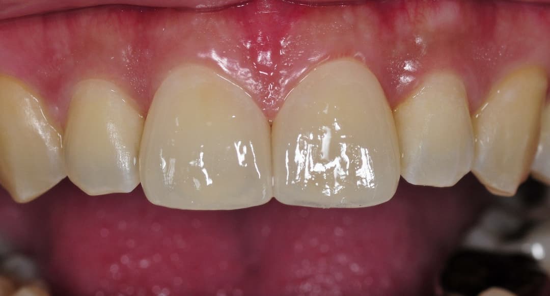 Ceramic procedure — After treatment