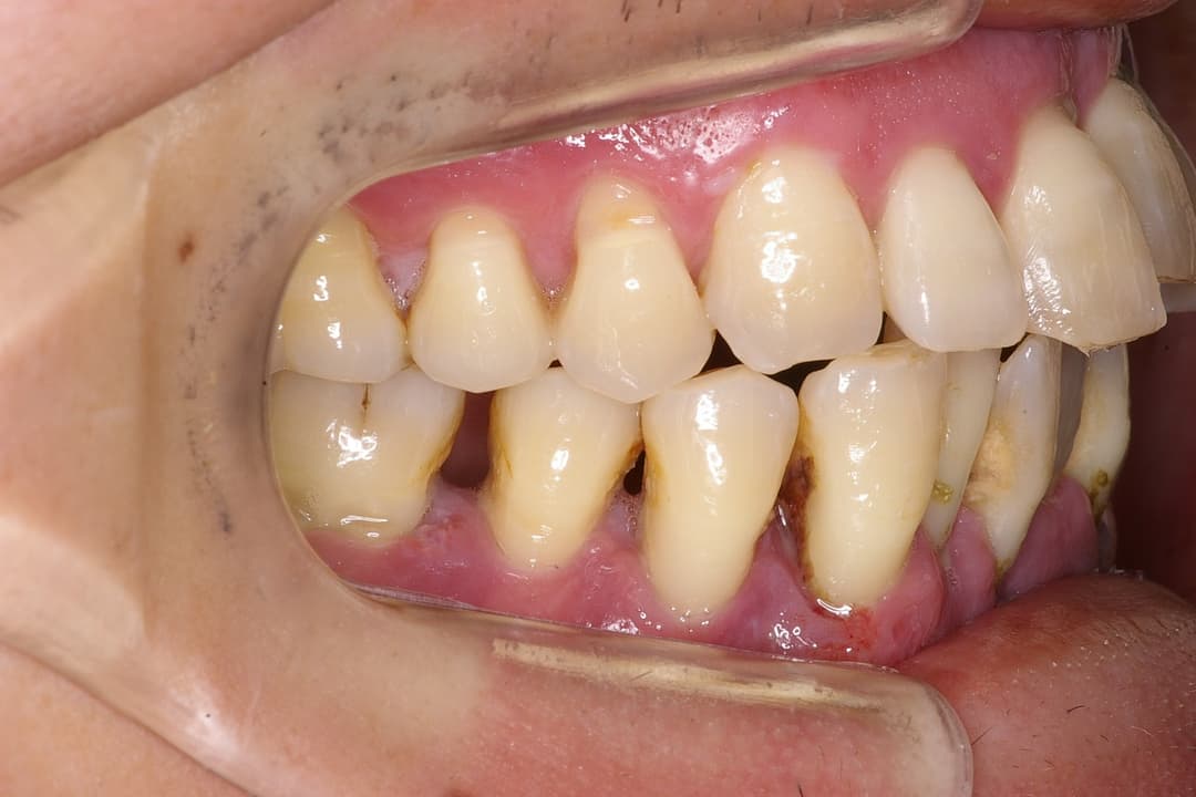 Dental implant — Before treatment