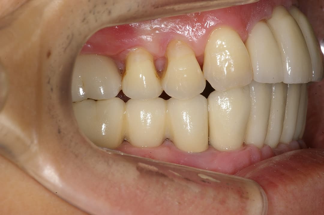 Dental implant — After treatment