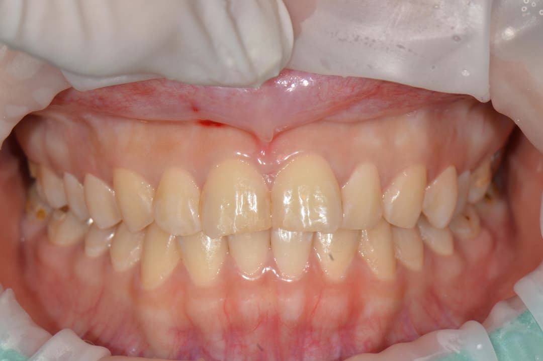 Dental laminate veneers — Before treatment