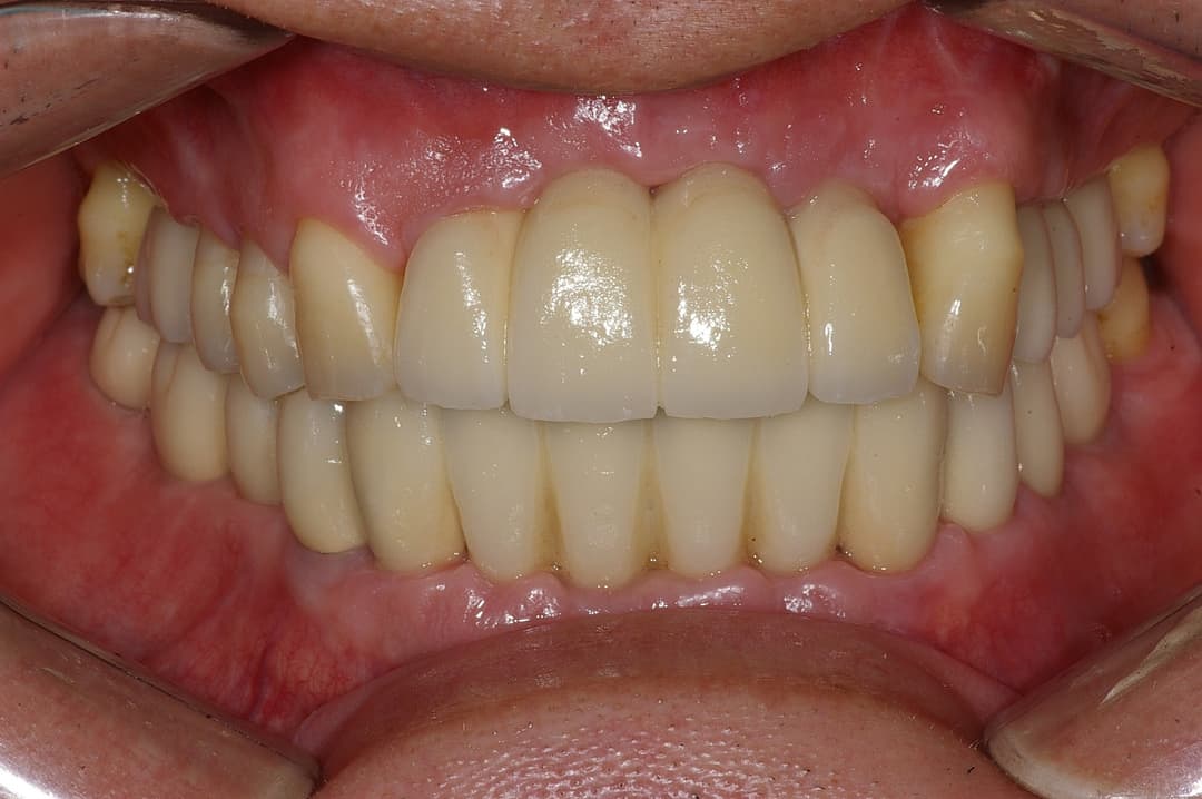 Dental implant — After treatment