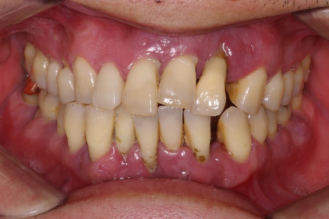 Dental implant — Before treatment