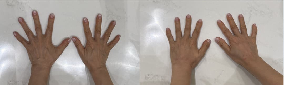 Radiesse — Before and after