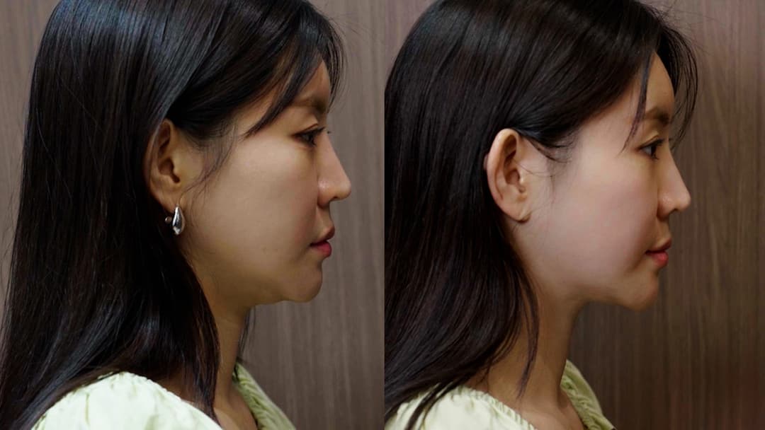 Alltight — Before and after