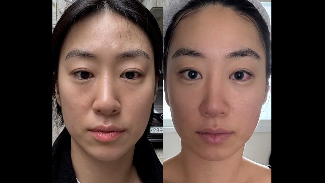 Olidia — Before and after