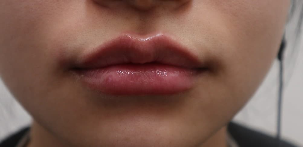 Lip filler — After treatment