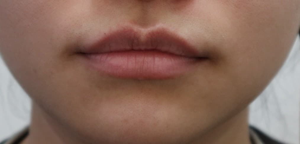 Lip filler — Before treatment