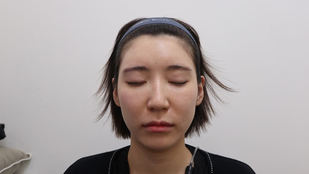 Forehead filler — After treatment