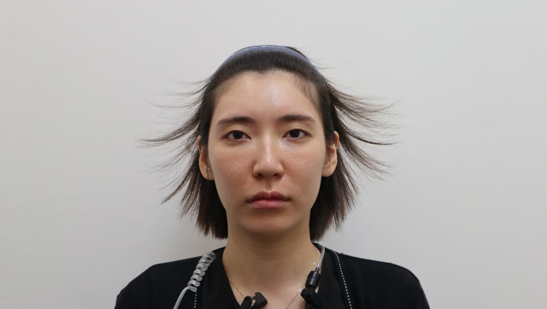 Forehead filler — Before treatment