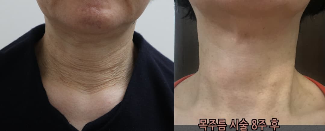 Radiesse treatment — Before and after